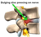 Sciatica help Tsawwassen