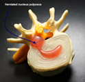 Sciatica help Tsawwassen