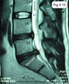Sciatica help Tsawwassen